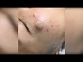 Popping huge blackheads and pimple popping  best pimple poppings 49