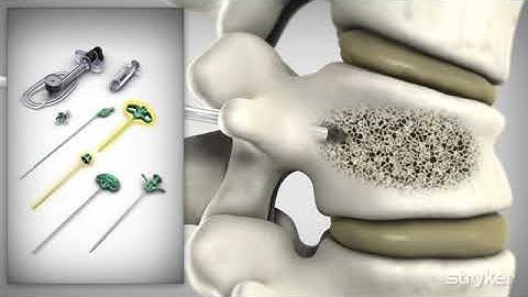 Stryker: iVAS Procedure with Cortoss Animation