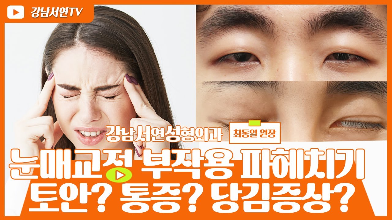 [Ганнам Соён гоо заслын эмнэлэг] Гоо заслын судалгаа | Нүдний зовхи засах мэс заслын гаж нөлөөний ташаа ойлголт ба үнэн | Лагофтальм уу? Өвдөлт үү? Татах мэдрэмж үү?