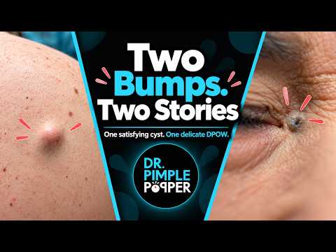 Two Bumps, Two VERY Different Pops | Dr. Pimple Popper