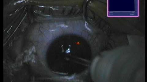 The first steps in developing the Athens Protocol for keratoconus: too-guided PRK followed by CXL
