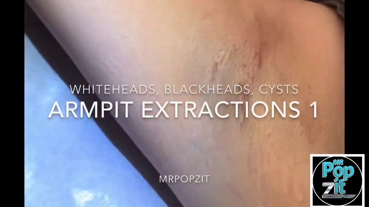 Sebaceous Cyst Armpit