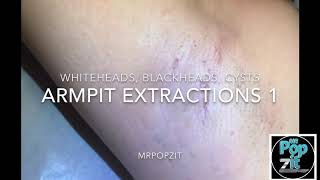 Armpit extractions #1. Blackheads, whiteheads, milia. Small cyst pops. Hidradenitis scars of axillae