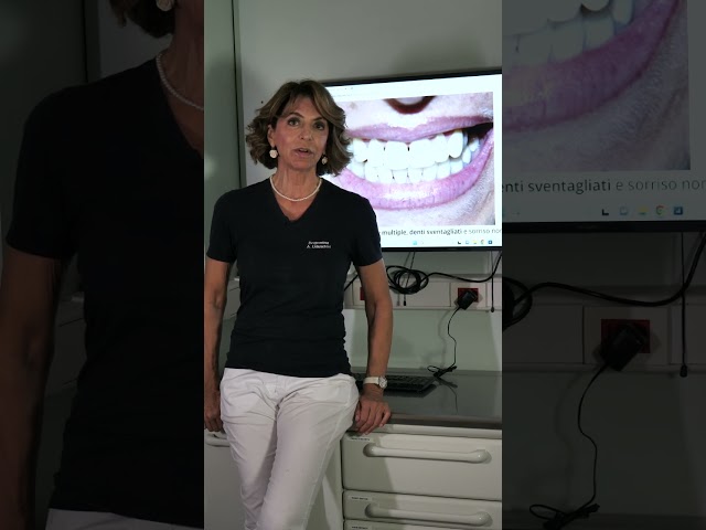 Come colmare gli spazi tra i denti?