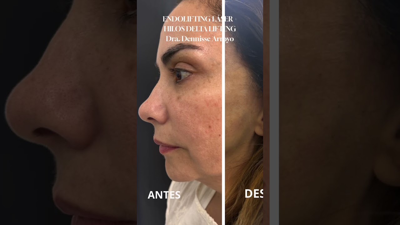ENDOLIFTING LASER - DRA DENNISSE ARROYO - REJUVENECIMIENTO FACIAL SIN CIRUGIA - LIMA, PERU