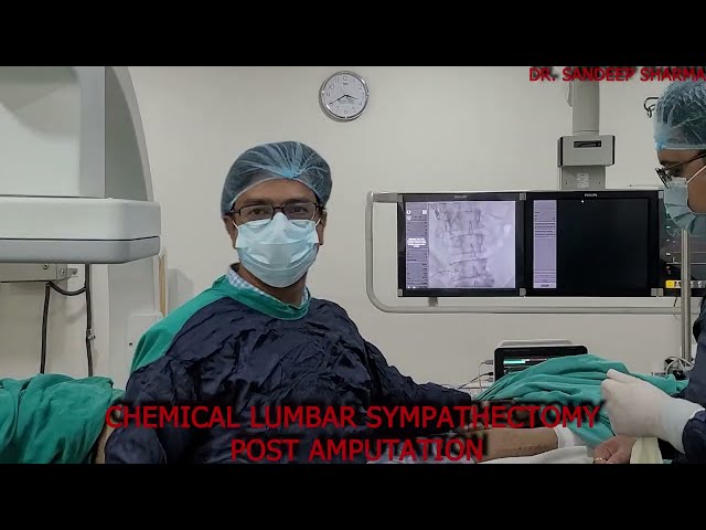 Bilateral Varicocele Embolization