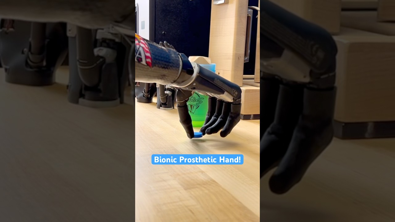 Myoelectric Prosthesis in Action: Joe’s Incredible Progress