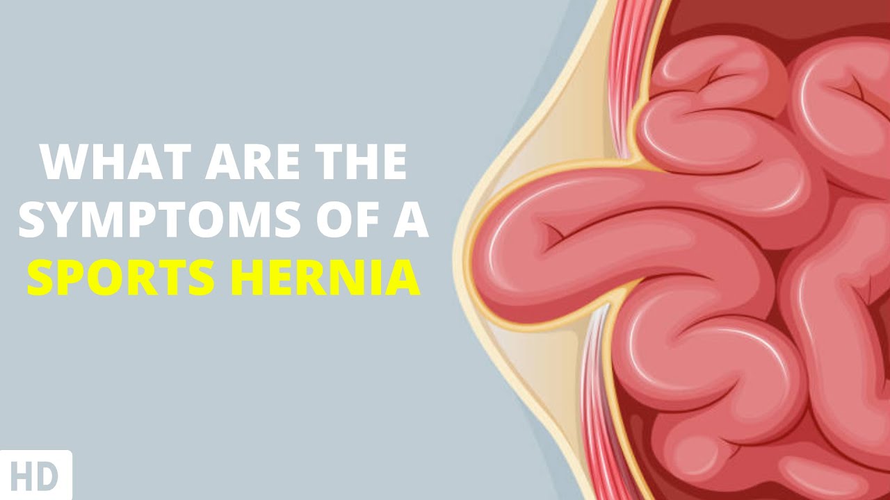 When Athletics Take A Toll Recognizing Symptoms Of A Sports Hernia when-athletics-take-a-toll-recognizing-symptoms-of-a-sports-hernia