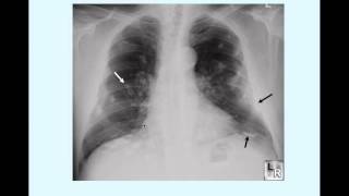 Asbestosis  CRASH! Medical Review Series