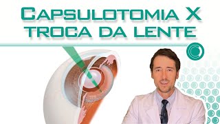Trocar a lente intraocular após capsulotomia.