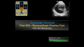 Ultrasound Case 210 - Haemorrhagic Ovarian Cyst with Clot Retraction