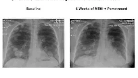 GRACEcast-144_Lung_Highlights in Lung Cancer, 2013: MEK Inhibitors for KRAS Mutation-Positive NSCLC