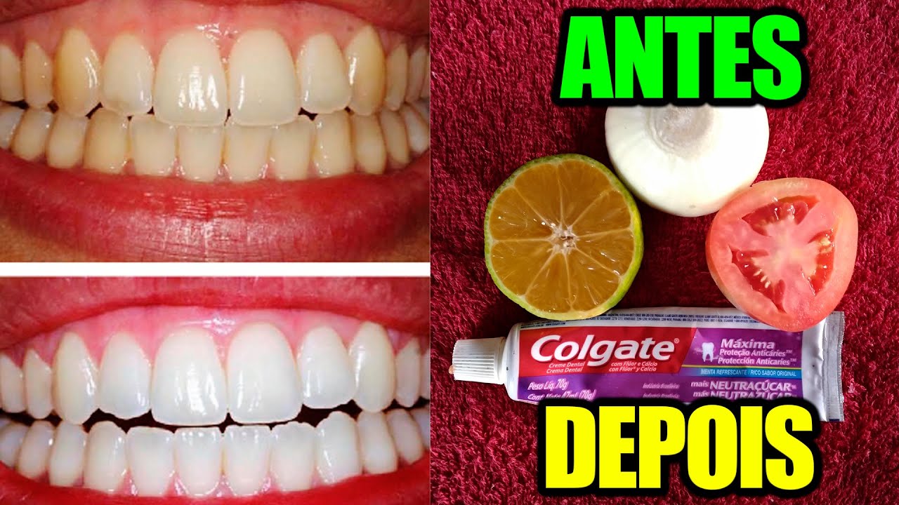 Como Deixar Os Dentes Brancos, Receita Para Clarear Os Dentes (É Muito ...