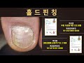 [특허관리] 열 발가락 발톱무좀 관리하기 / Managing 10 Toenail Fungus