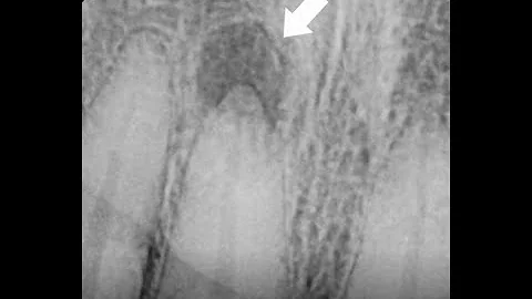 Do I Always Need A Root Canal After Getting A Dental Crown Done ?