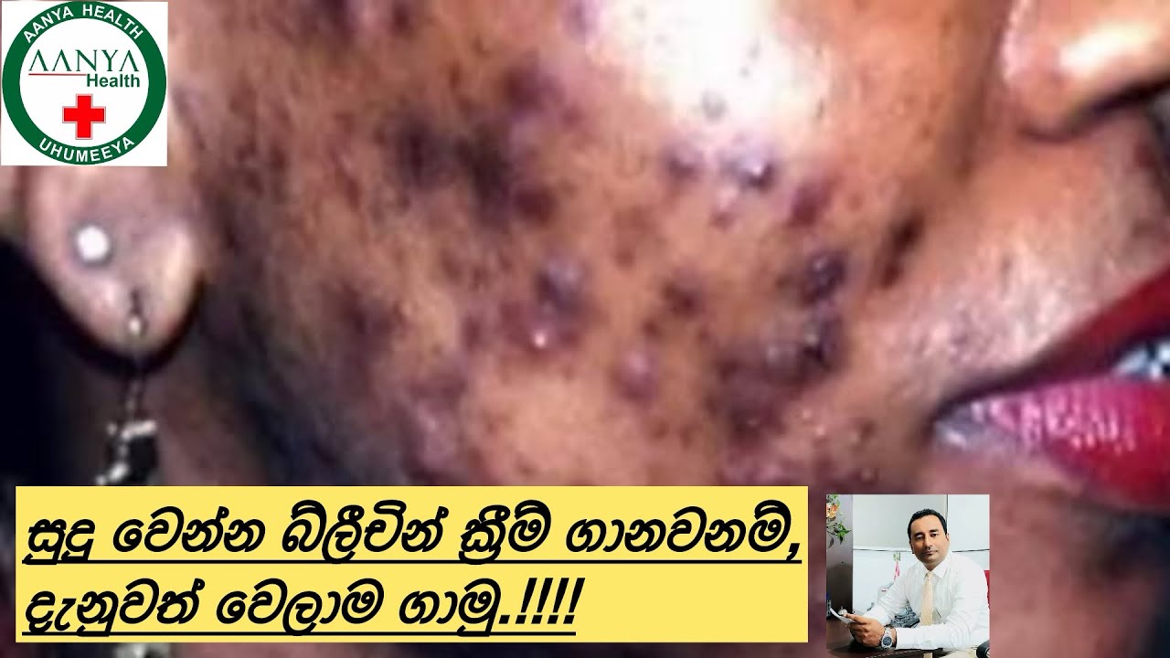 බිලිචින් ක්‍රීම්  ගාල සුදු වෙන්න පුළුවන්ද?කොහොමද නිවරදිව සම සුදු කර ගන්නෙ.?#whitningtips#glowingskin