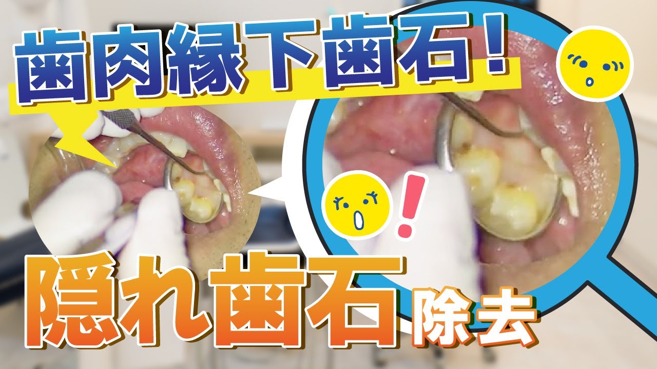 縁 下 歯石