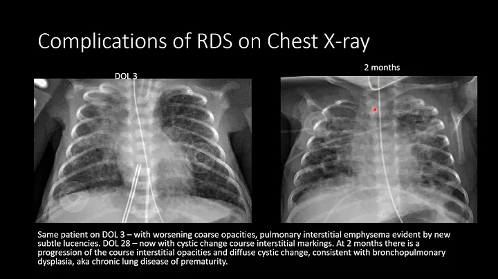 Radiographic Manifestations of Neonatal Surfactant Deficiency Syndrome