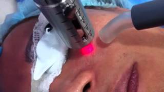 En tratamiento con láser india poros en para costo facial