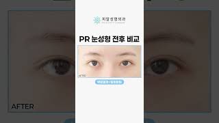 [피알성형외과] 눈성형 전후 비교｜부분절개+앞윗트임