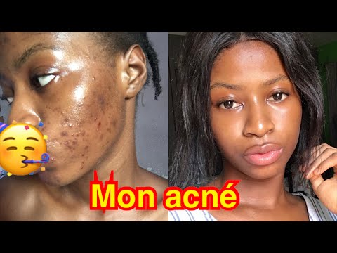 Comment se débarrasser des boutons en 24 heures