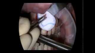 LIVE OPERATION Root Tip Resection with retrograde Filling