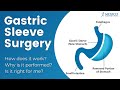 Reinforced gastric sleeve surgery in mexico  mexico bariatric center