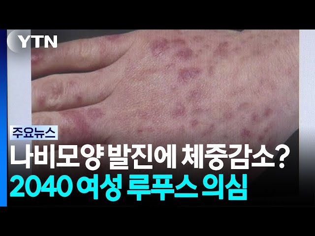 나비모양 발진에 체중 감소?...2040 여성이라면 루푸스 의심 / YTN
