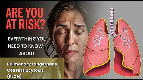 Pulmonary Langerhans Cell Histiocytosis (PLCH) Explained Causes, Symptoms and Treatment, All