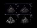 Heart base tumor in dog echocardiography