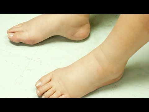 [ Watch Now ] 7 Tips to Treat Swollen Feet in Diabetics - Health Tips