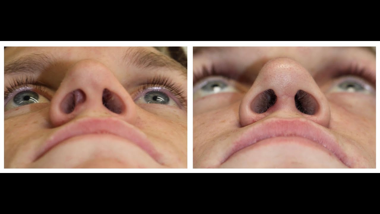 Septal replacement graft how I manage the septum YouTube