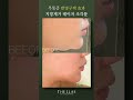 울쎄라 통증 때문에 이중턱 지방제거를 못할때 받아야할 무통증 지방제거 레이저 l #울쎄라 #shorts