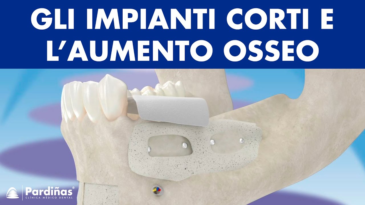 Gli impianti corti e l’aumento osseo mandibolare ©