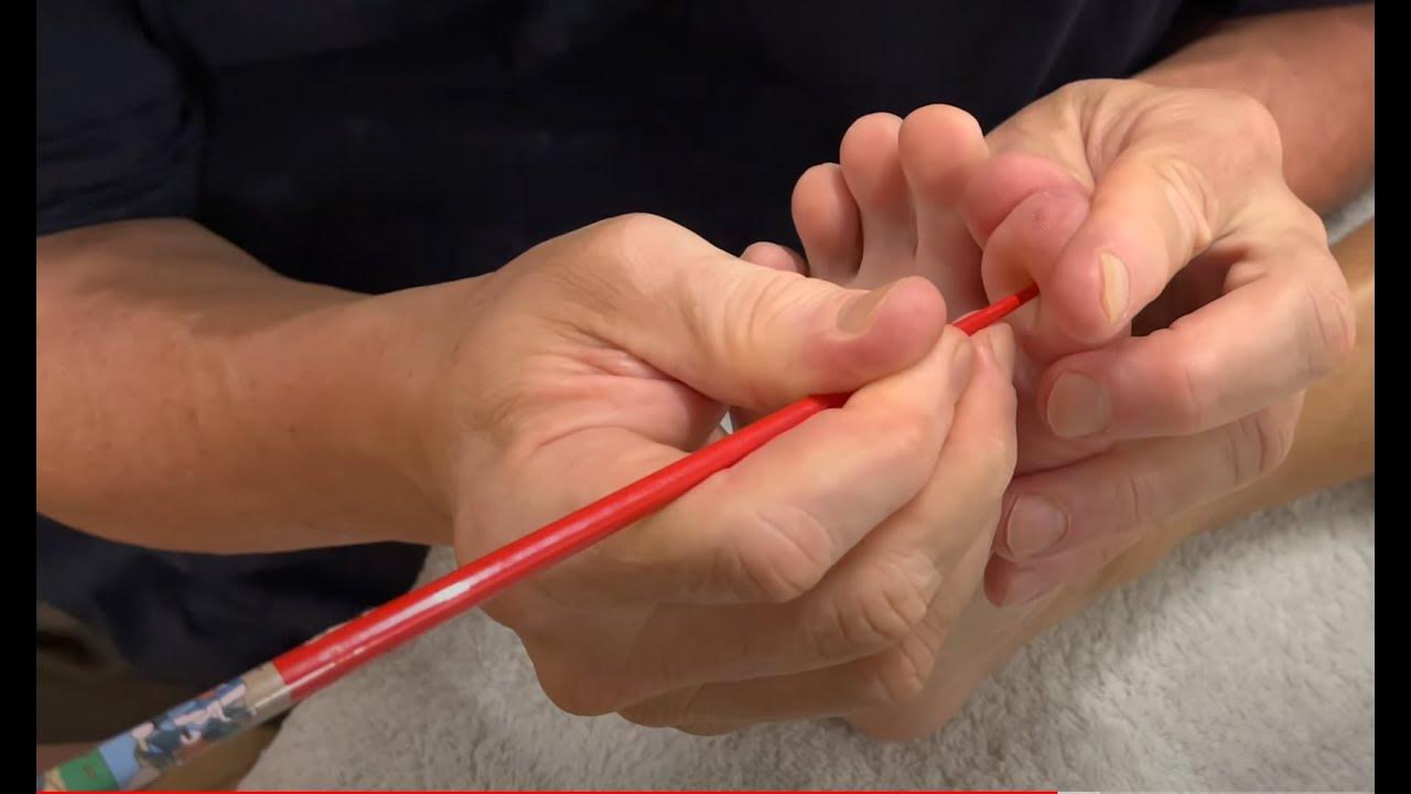Deep foot massage using chopsticks. Brandon working on Paul part 1