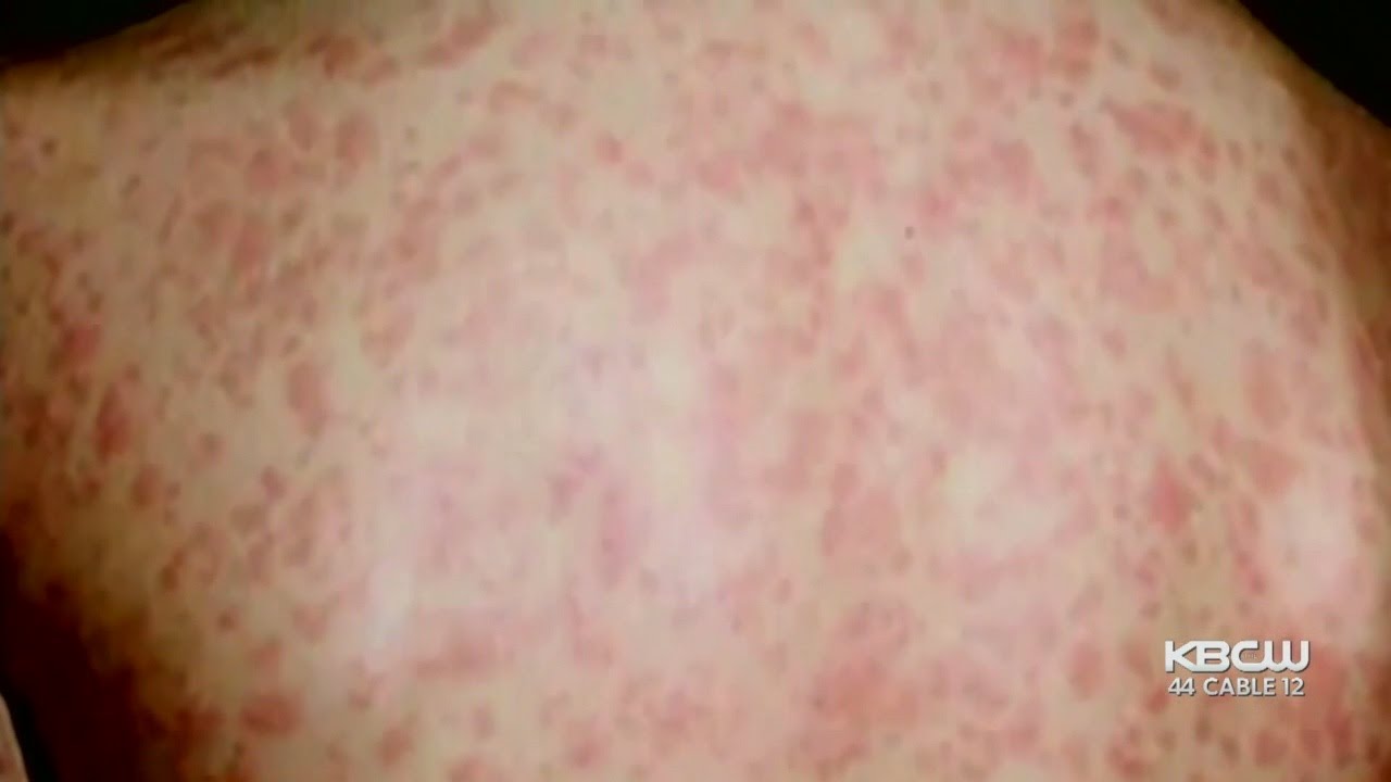 Silicon Valley Visitor May Have Exposed Thousands To Measles - YouTube