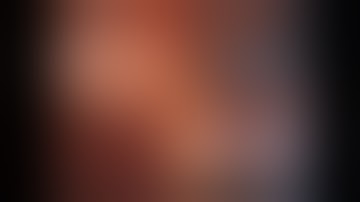 robotic pelvic lymph node dissection by Dr Geoff Coughlin 2017