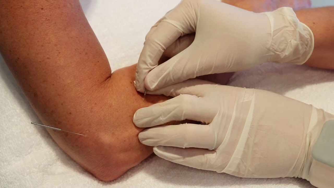 Dry needling to treat Tennis Elbow YouTube
