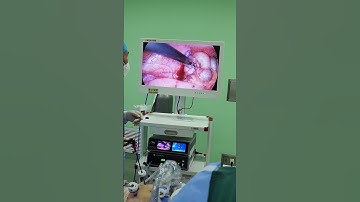 Laparoscopic Appendectomy