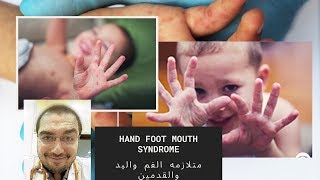 متلازمه الفم واليد والقدمين فالأطفال  HAND FOOT MOUTH SYNDROME in children