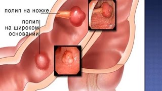 Полипы в кишечнике, полипы прямой кишки, геморрой внутренний и наружный, запор, лечение, причины(ОБРАЩАЙТЕСЬ ☎ - ✓ ВКонтакте: http://vk.com/biomedis1 ✓ Oдноклассники: http://ok.ru/biomedis1 ✓ Skype: perfect-health Полипы в кишечни..., 2015-11-13T18:07:31.000Z)