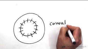Keratoconus and Crosslinking - a whiteboard video by Dr. Lemanski