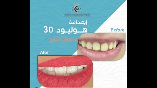 السعودي الاوربي 🦷 لطب الاسنان 😍😁زراعة الاسنان ب 1800 ريال