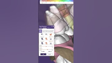 INSTANT MORPH occlusion in exocad