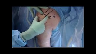 Rotator cuff surgery | Ohio State Sports Medicine