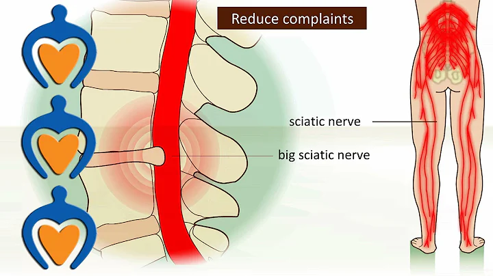 Lower back pain (a.o. sciatica, herniated disk) - It's causes, symptoms and treatment. - DayDayNews