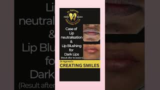 Lip blushing for dark/black/pigmented/vitiligo lips Painless way to get pink Lips by Dr.Ankita