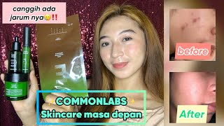 HONEST REVIEW COMMONLABS |Acne prone skin must have!⭐️⭐️⭐️⭐️⭐️ | Canggih ada jarum nya🔥😭