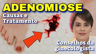 Adenomiose: Você Já Conhece Esta Condição? Adenomiose: Você Já Conhece Esta Condição?