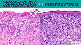 Langerhans Cell Histiocytosis vs Mastocytosis (Hemepath for Dermatopathology Pathology Dermatology)